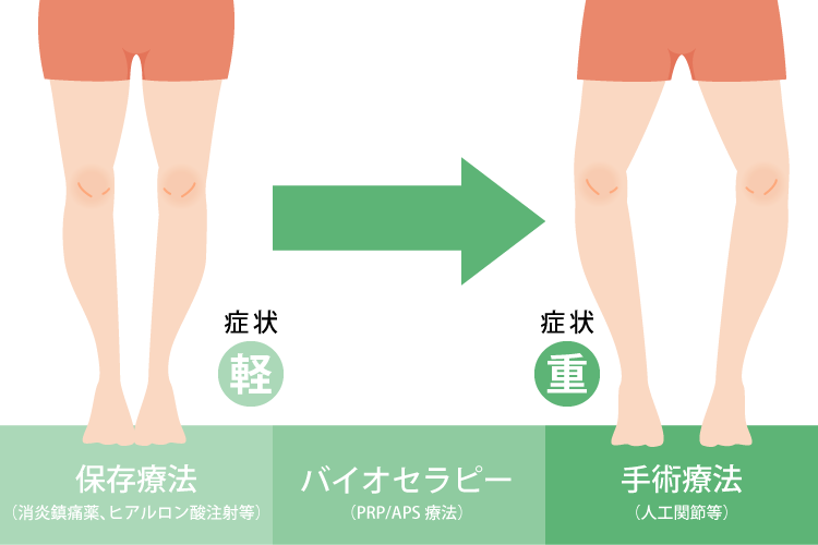変形性膝関節症に対する再生医療